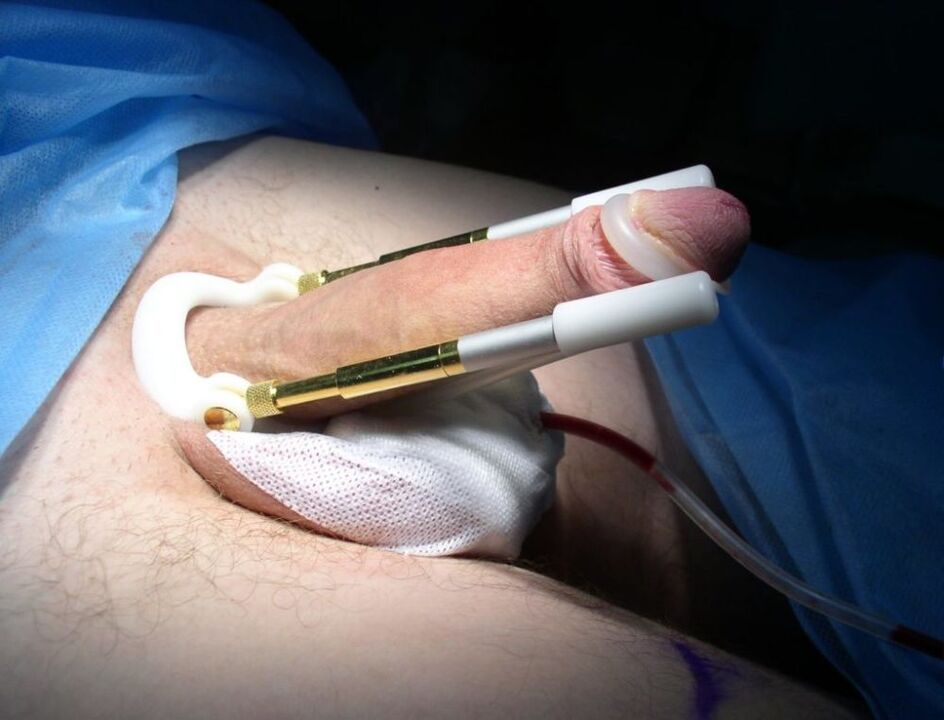 wearing an extender after surgery