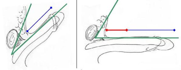 An increase in the length of the penis due to the crossing of the ligament