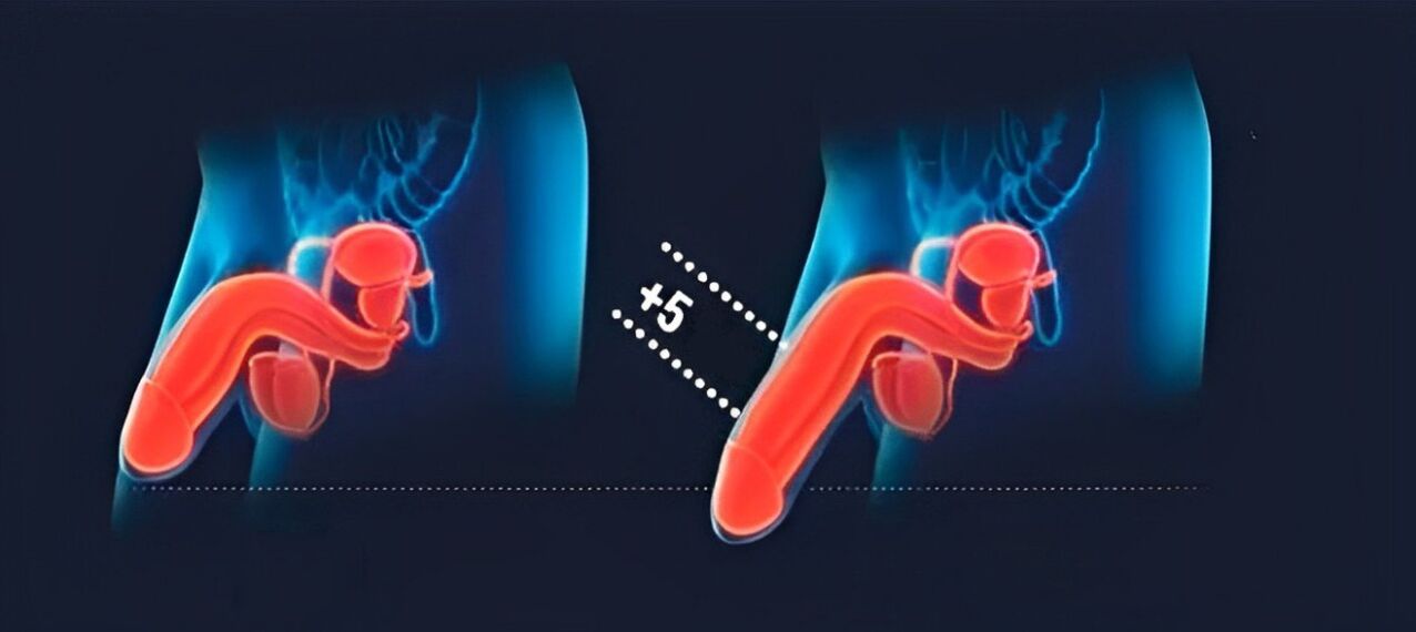 penis enlargement results in hyaluronic acid