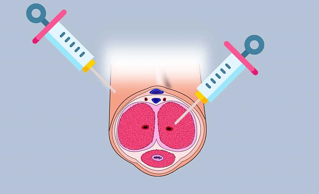 places for hyaluronic acid injections