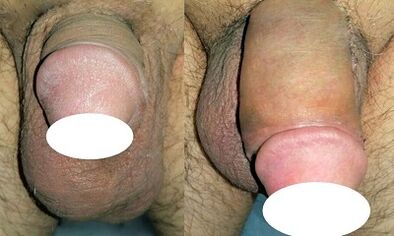 Photo before and after a penis increase