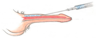 injection of dick filler
