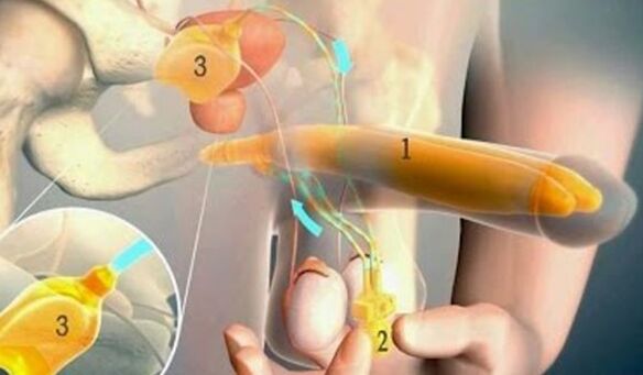 A phalloprosthesis that enlarges the male sexual organ