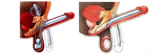 Phalloprosthetics with inflatable prosthesis (left) and plastic (right)